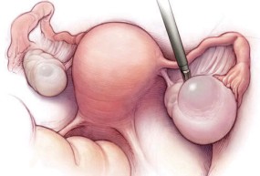Obat Penyakit Kista Ovarium Tanpa Operasi